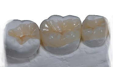 INTARSI IN CERAMICA E ZIRCONIA